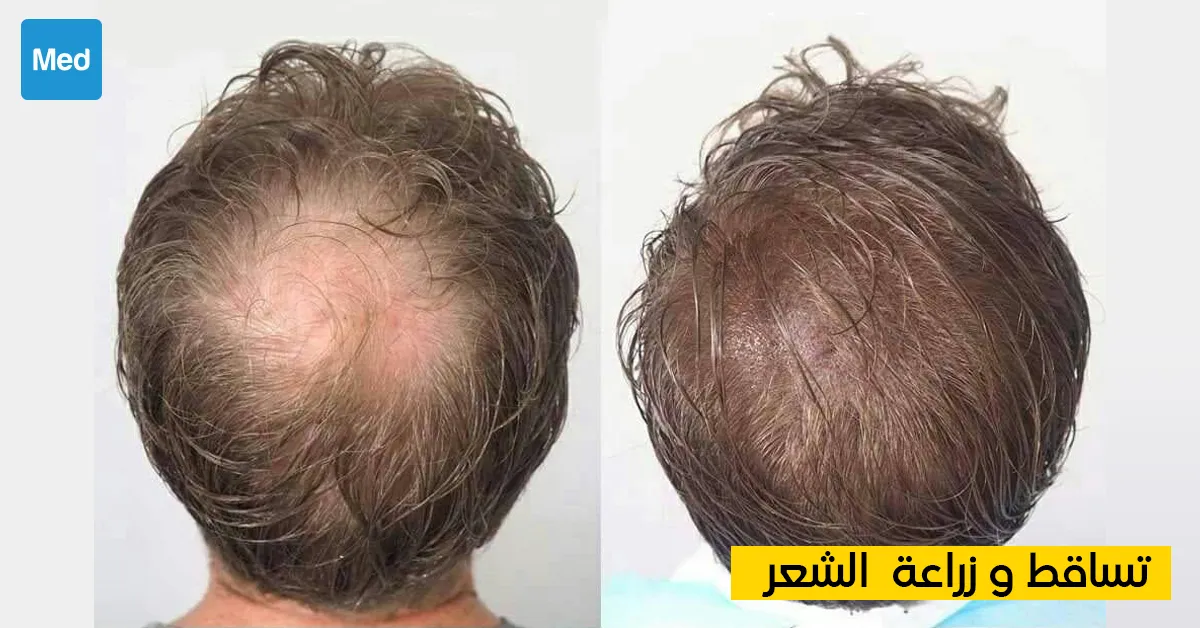 تساقط وزراعة الشعر